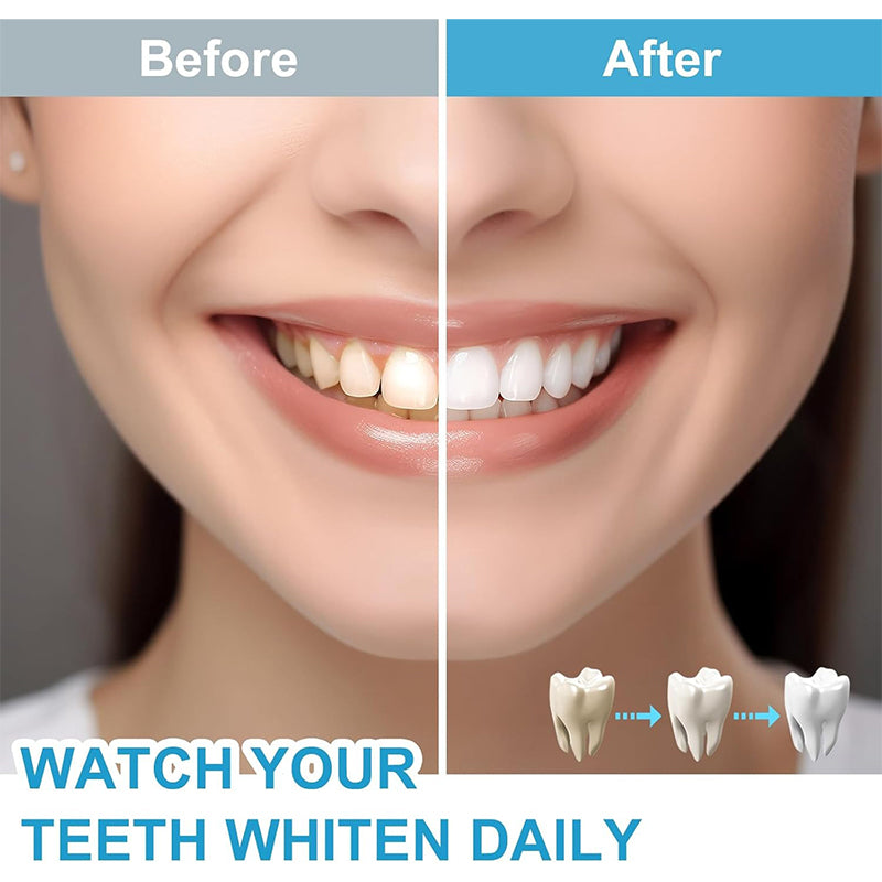 Teeth Whitening Kit