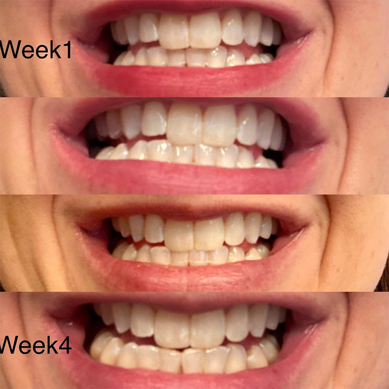 Teeth Whitening Kit